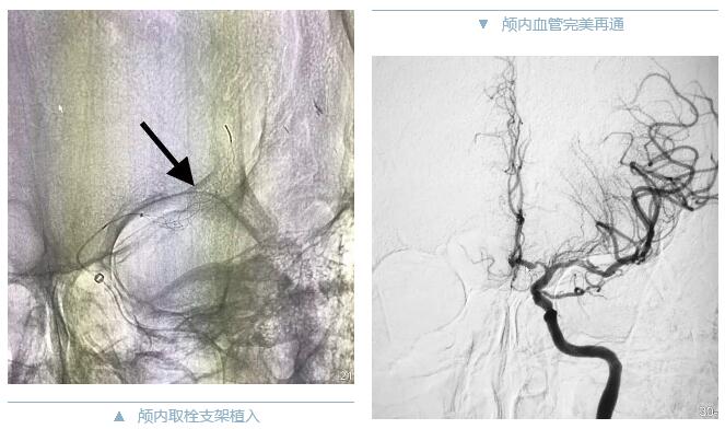 拼2-颅内取栓、再通.jpg