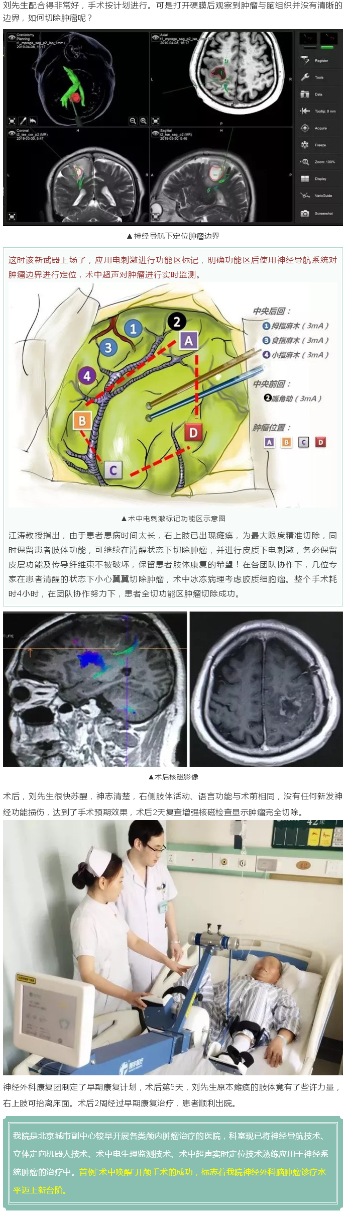 “唤醒”沉睡的肢体——潞河医院神经外科成功实施多学科协作 “术中唤醒”手术治疗功能区肿瘤---2.jpg